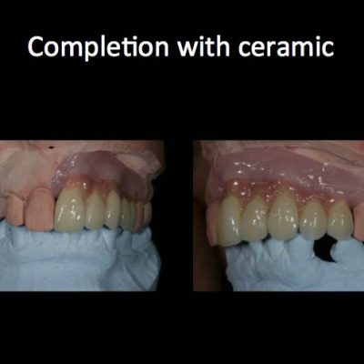 Implant Restorations 2