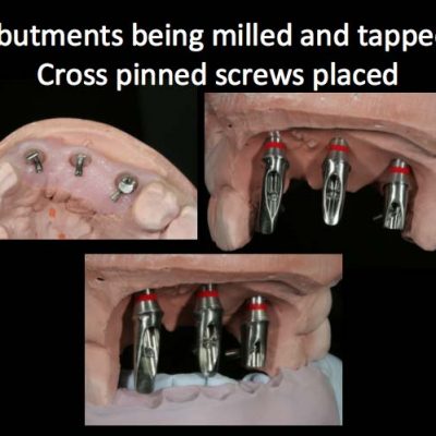 Implant Restorations 2