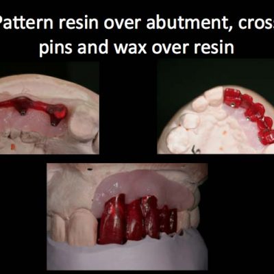 Implant Restorations 2