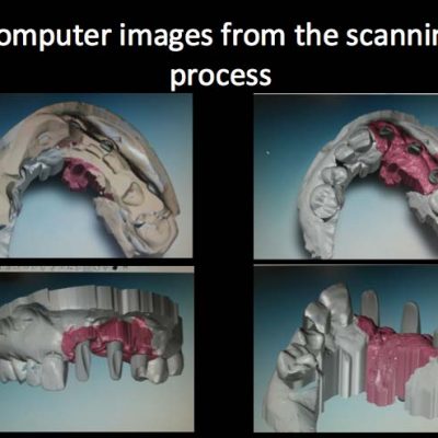 Implant Restorations 2