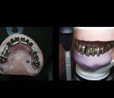 Implant Resotrations 1