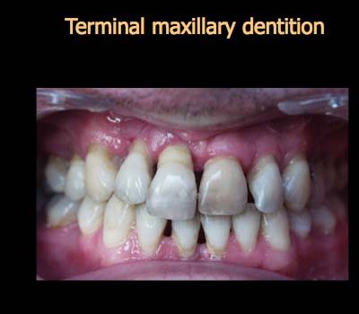 Implant Resotrations 1