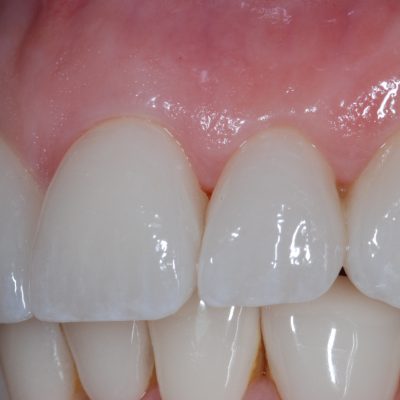 Completed2 - emax veneers