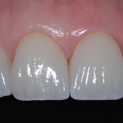 Completed4 - emax veneers