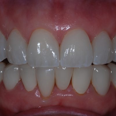 Completed5 - emax veneers