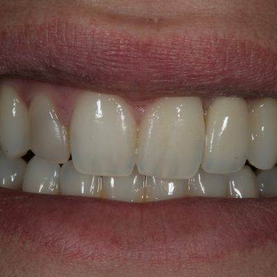 Zirconia Abutment and Crown