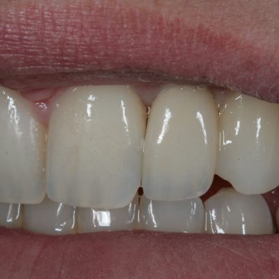 Zirconia Abutment and Crown