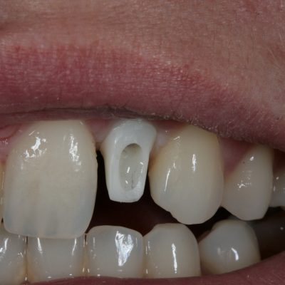 Zirconia Abutment and Crown