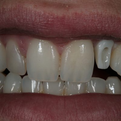 Zirconia Abutment and Crown