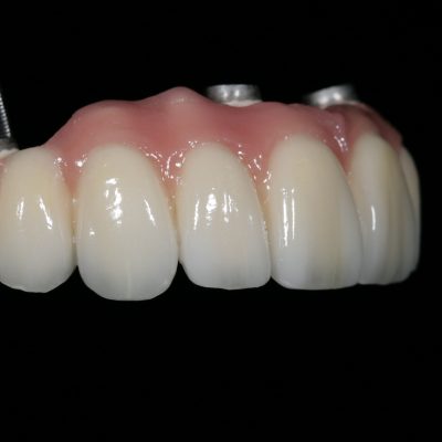 Implant Restorations 2