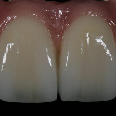 Implant Restorations 2