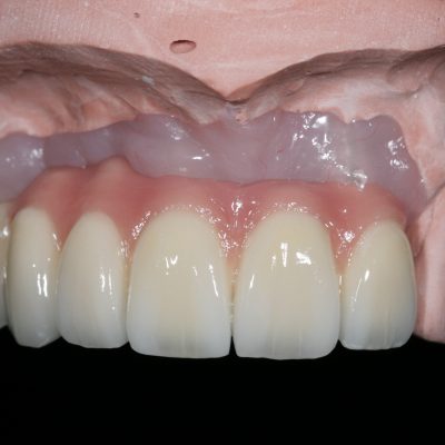 Implant Restorations 2