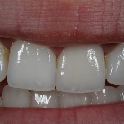 Left central implant crown - Anterior Implant Restorations