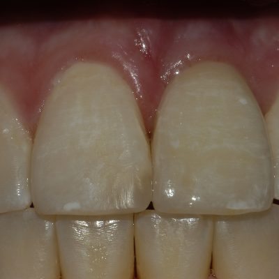 Left implant central - Anterior Implant Restorations