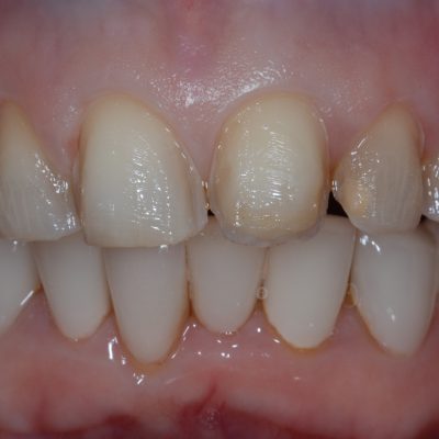 Preps - emax veneers