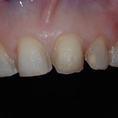 Preps2 - emax veneers