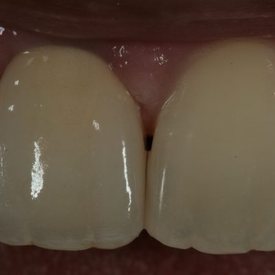 right central incisor crown - Anterior Implant Restorations