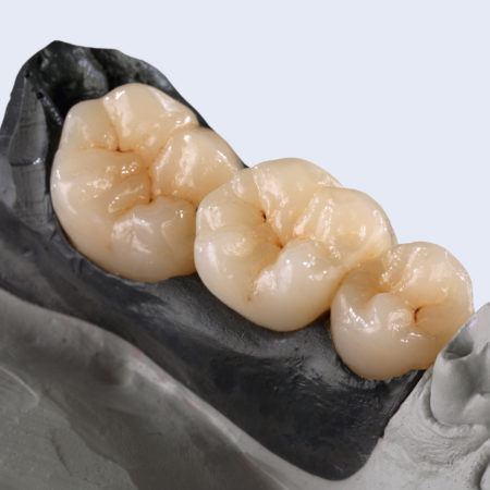 AG_Showcase_Ceramill_Zolid_FX_Preshades